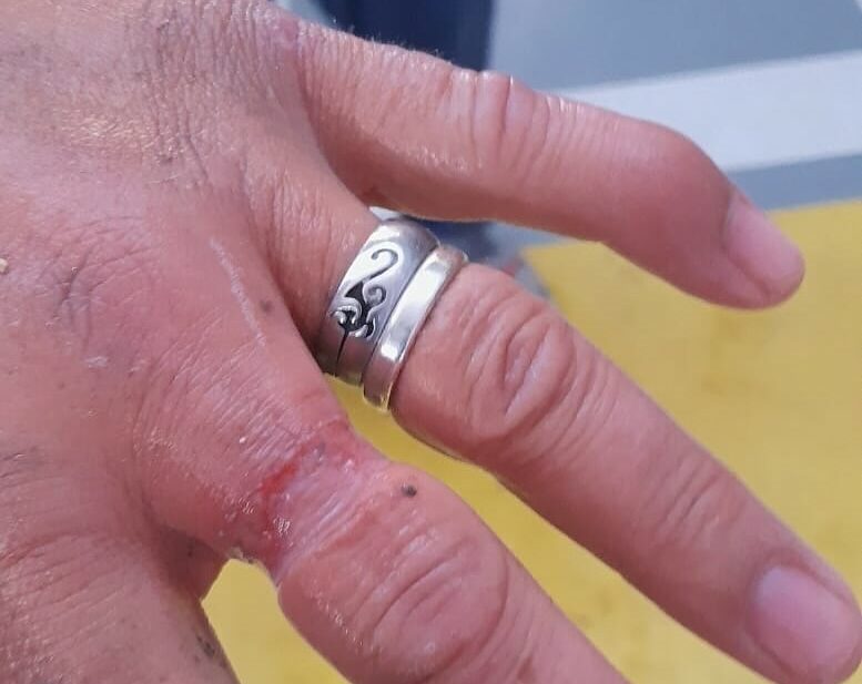 Bomberos del Consorcio retiran un anillo que dañaba el dedo corazón a un vecino de Pantoja